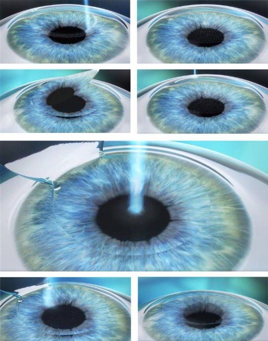 фемто супер ласик